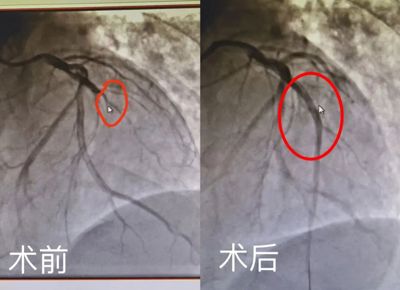 0401【生死时刻，全力以赴】武宁县人民医院成功抢救一名急性心肌梗死患者