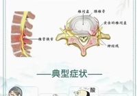 【健康科普】武宁县人民医院外一科：走路腰疼，双腿乏力，您可能患有腰椎管狭窄症