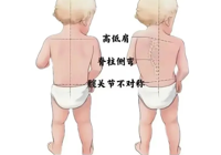 【健康科普】高考体检脊柱侧弯高发！孩子脊柱健康，千万别忽视