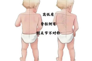【健康科普】高考体检脊柱侧弯高发！孩子脊柱健康，千万别忽视
