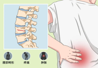【健康科普】一声咳嗽就骨折？老人腰痛别硬扛！警惕骨质疏松性腰椎骨折