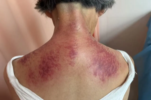 【以通为治 砭到病除】中医科特色疗法：李氏虎符铜砭刮痧治疗颈椎病