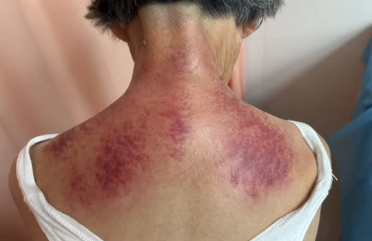 【以通为治 砭到病除】中医科特色疗法：李氏虎符铜砭刮痧治疗颈椎病